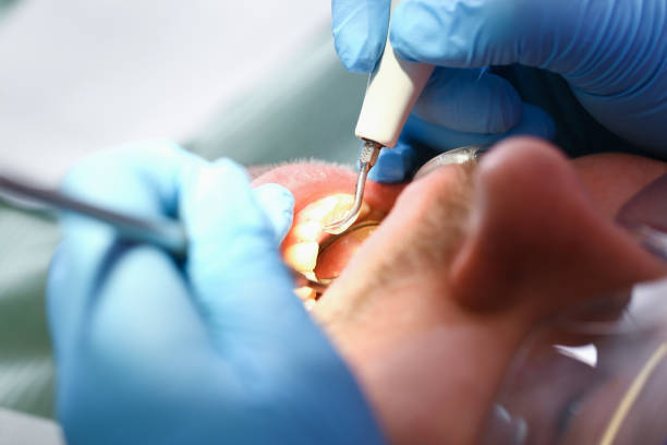 Best Emergency Tooth Extraction in Columbia, MD